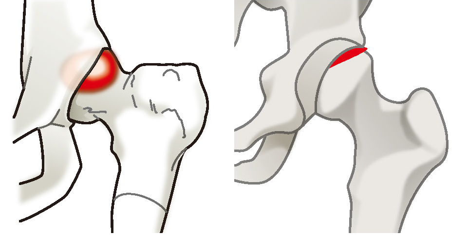股関節インピンジメントと関節唇損傷