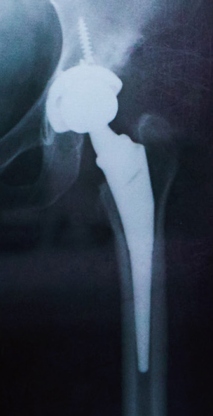人工股関節置換術後の
レントゲン