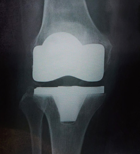 人工膝関節全置換術後のレントゲン