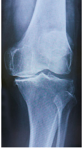 変形性膝関節症のレントゲン