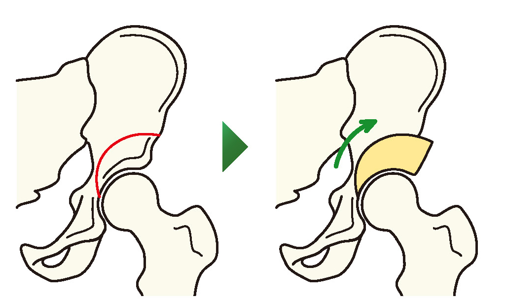寛骨臼回転骨切り術