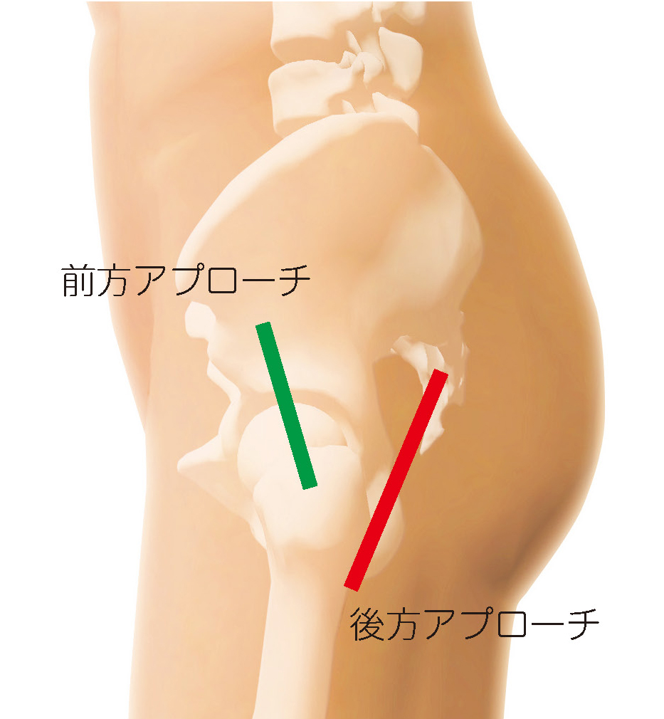 前方アプローチと後方アプローチ