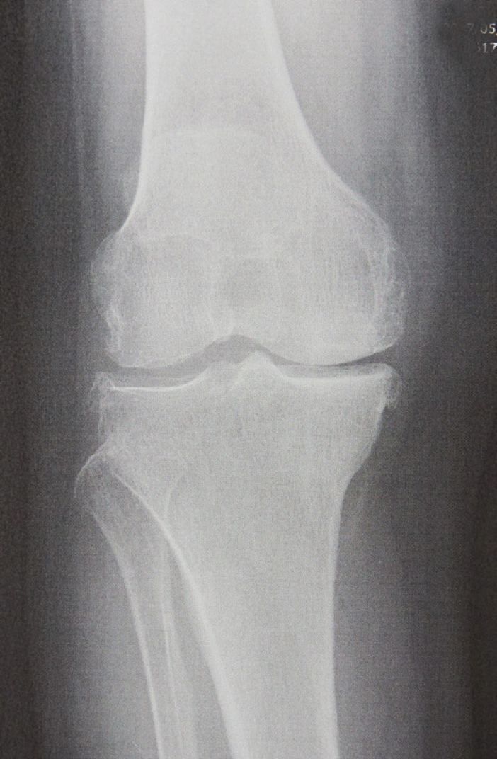変形性膝関節症のレントゲン