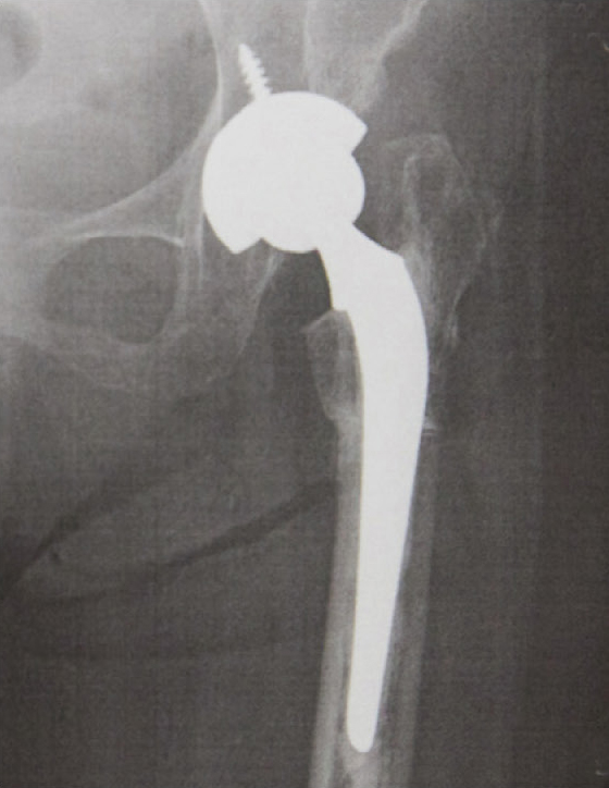 人工股関節置換術後のレントゲン