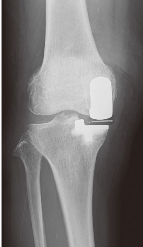 片側置換術後のレントゲン