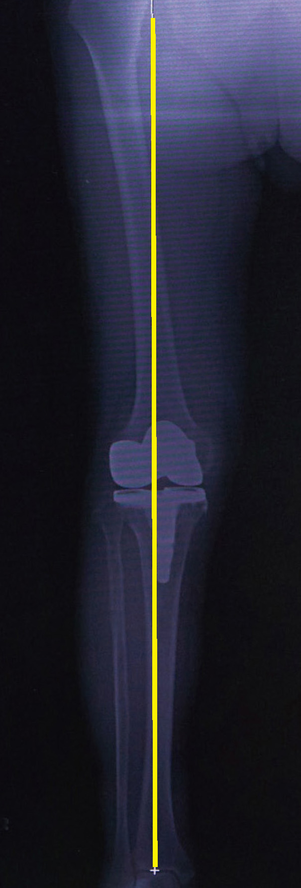 人工膝関節全置換術後のレントゲン（体重がかかる軸が膝の真ん中を通っています）