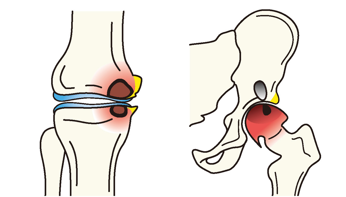 壊死（膝関節と股関節）