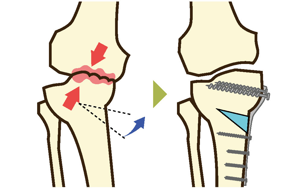 膝関節の骨切り術
