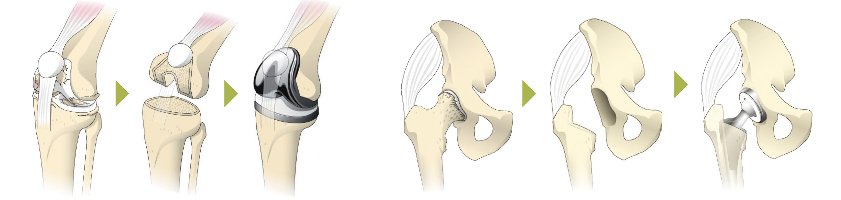 人工関節の流れ（膝関節と股関節）