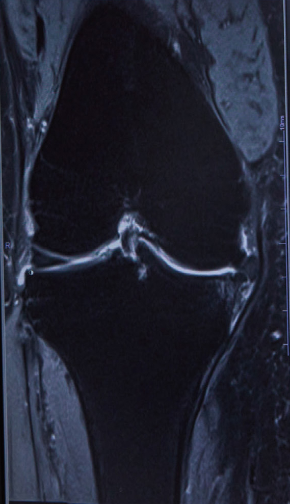 膝関節のMRI画像