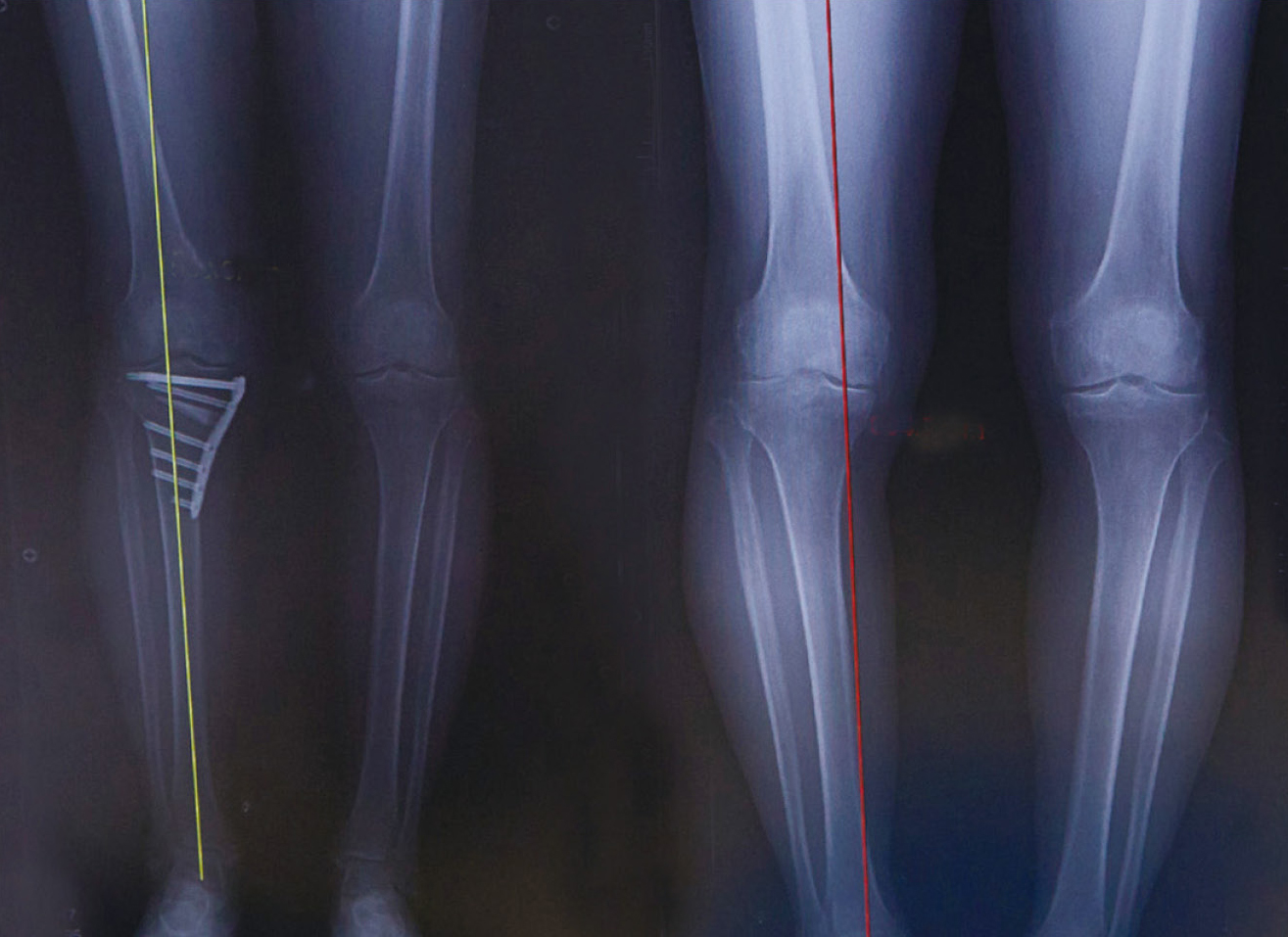 骨切り術後のレントゲン手術前（右）に比べ脚が真直ぐになり、重心も真ん中を通っています。