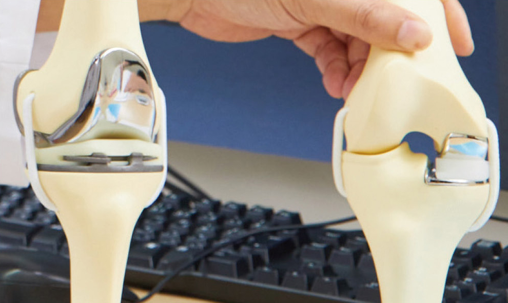 人工股関節置換術後の膝の痛みはどのくらい続きますか?