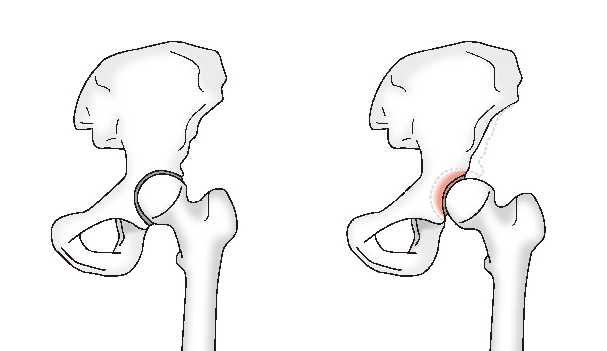 正常な股関節と臼蓋形成不全