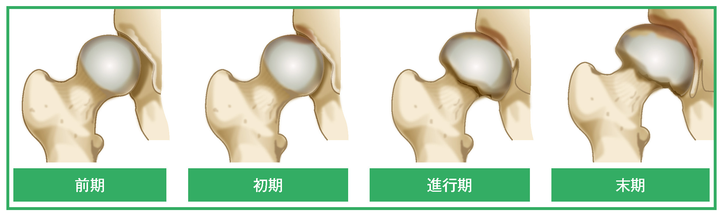 変形性股関節症の4段階