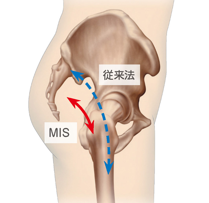 従来法とMIS の皮膚切開の大きさのイメージ