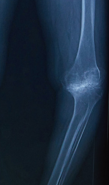 膝の変形が進行したレントゲン