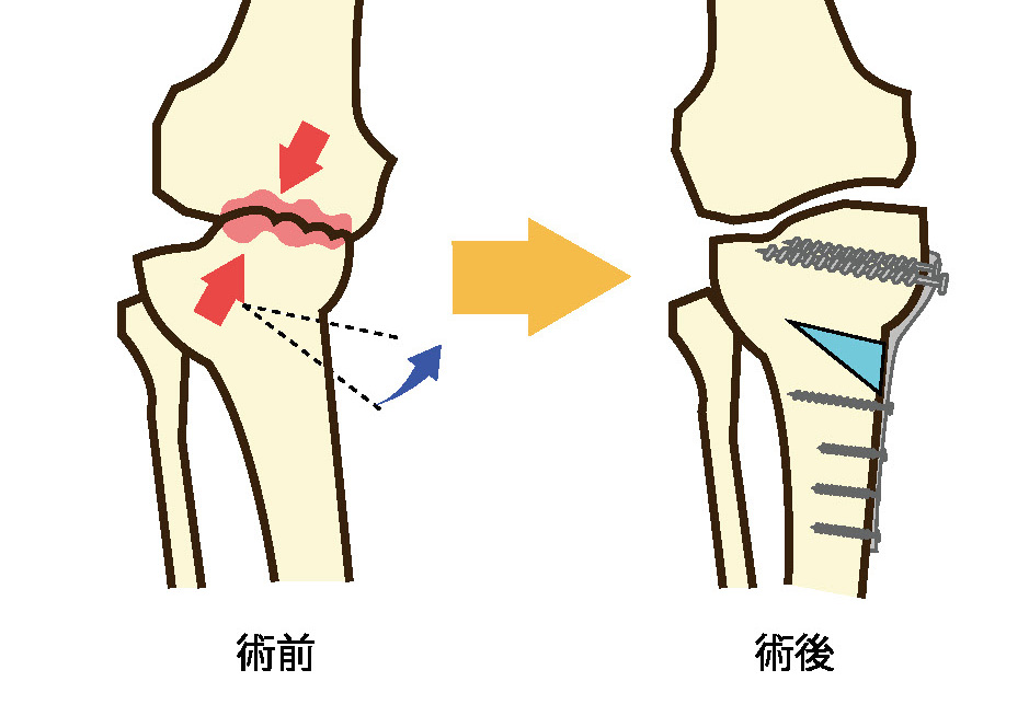 骨切り術