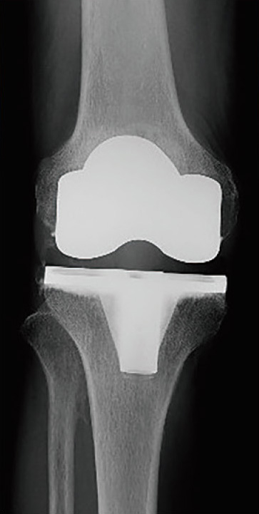 全置換術後のレントゲン