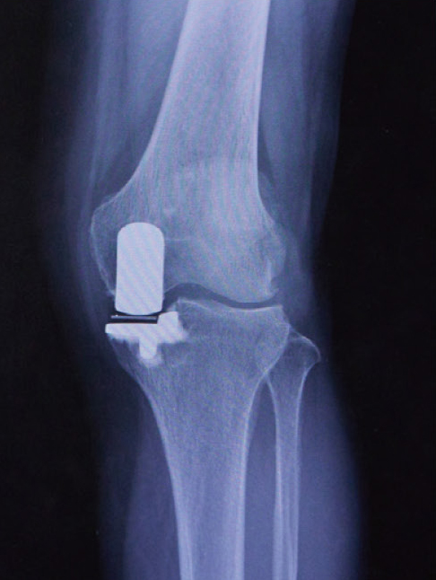 人工膝関節部分置換術後のレントゲン