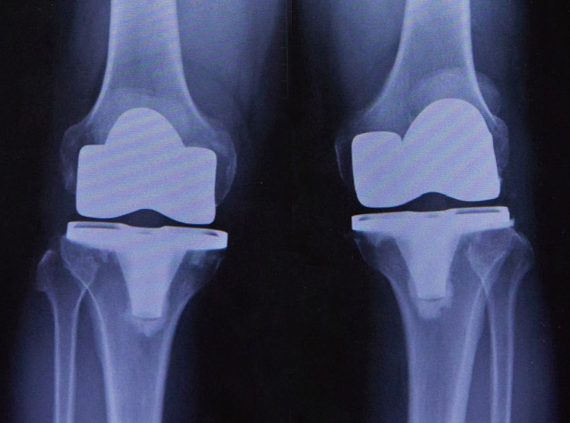 人工膝関節置換術後のレントゲン（両脚）