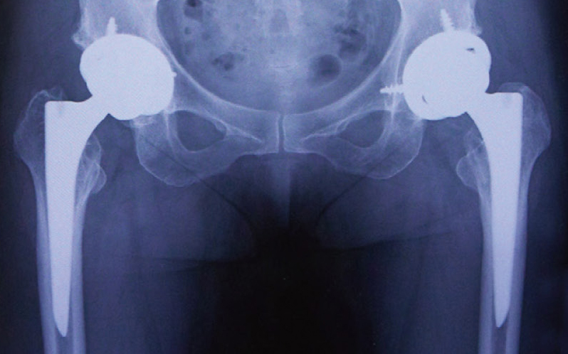人工股関節置換術後のレントゲン（両脚）