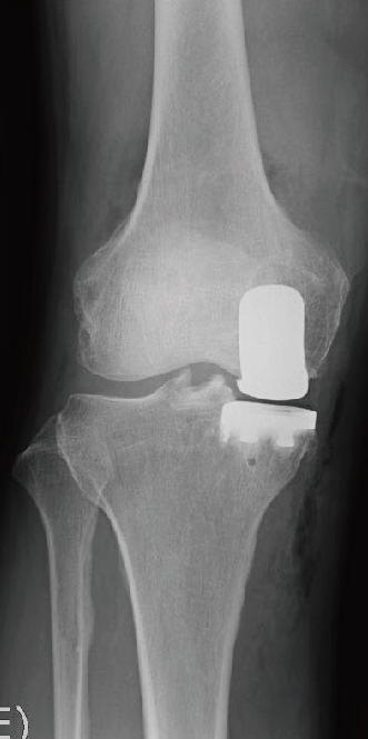 人工膝関節単顆置換術