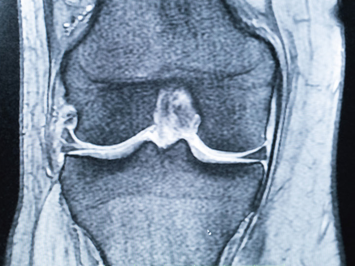 傷んだ膝関節のMRI
