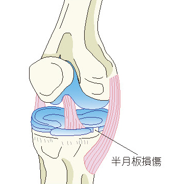 半月板損傷