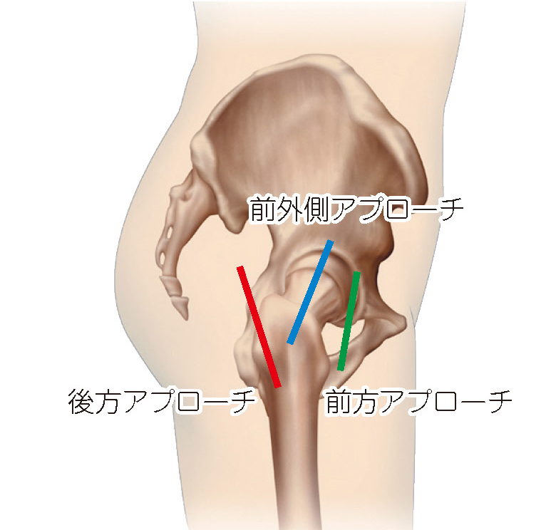 前方アプローチと後方アプローチ