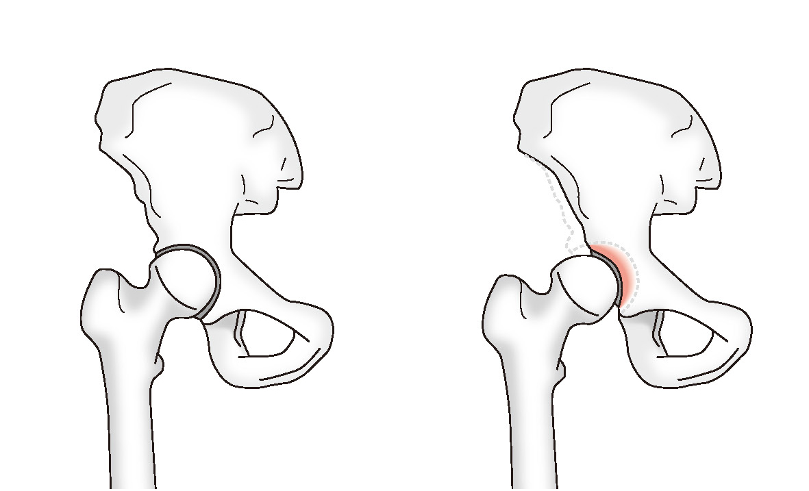 正常な股関節と発育性股関節形成不全