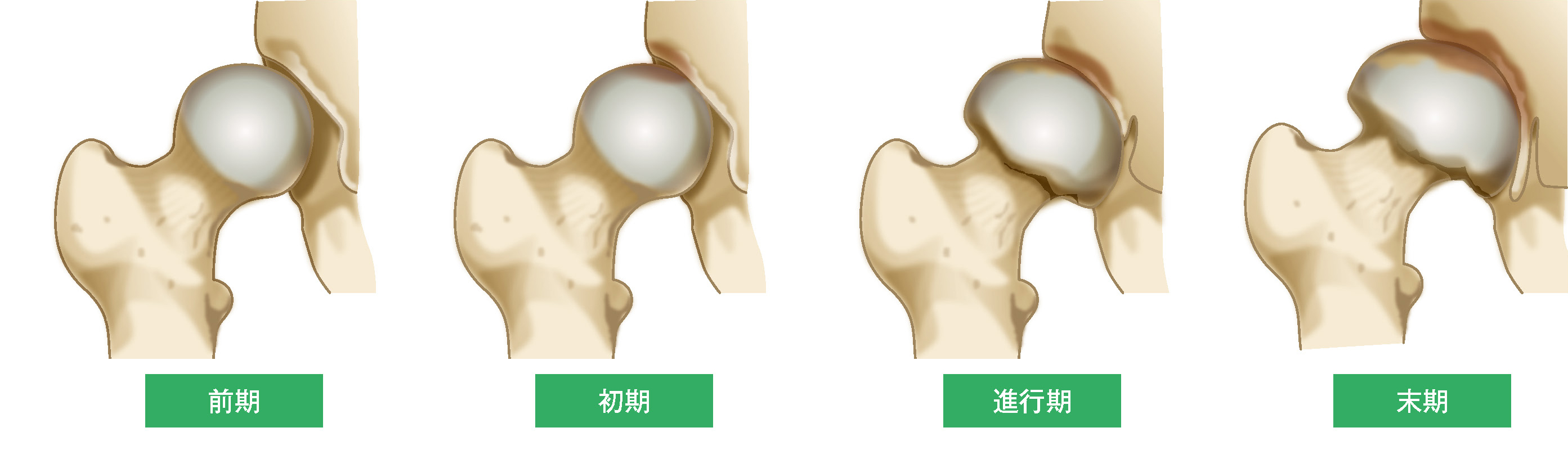 変形性股関節症の4段階