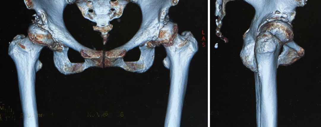 変形性股関節症のCT（正面と側面）