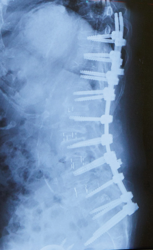 脊椎の治療後のレントゲン