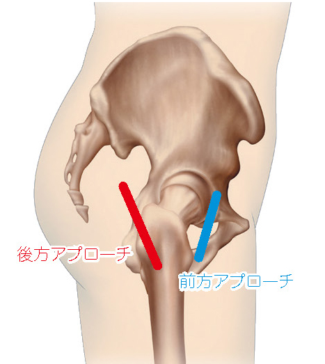 前方／後方アプローチ