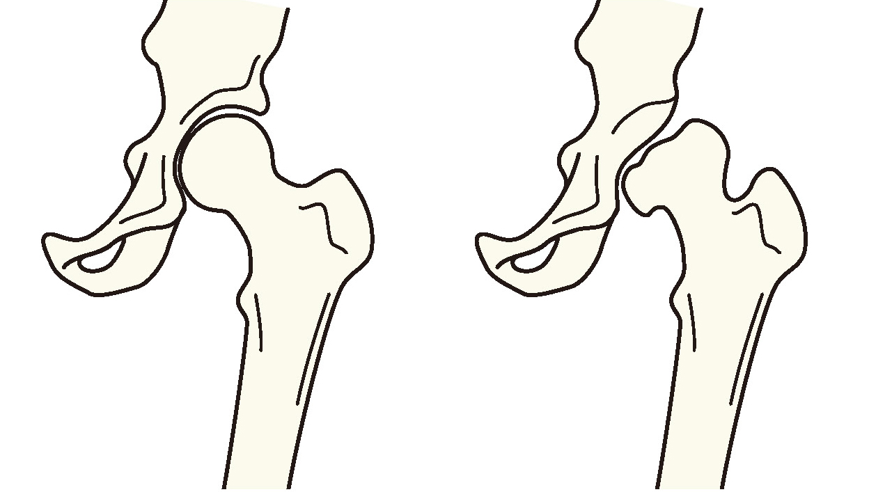 通常の股関節と臼蓋形成不全