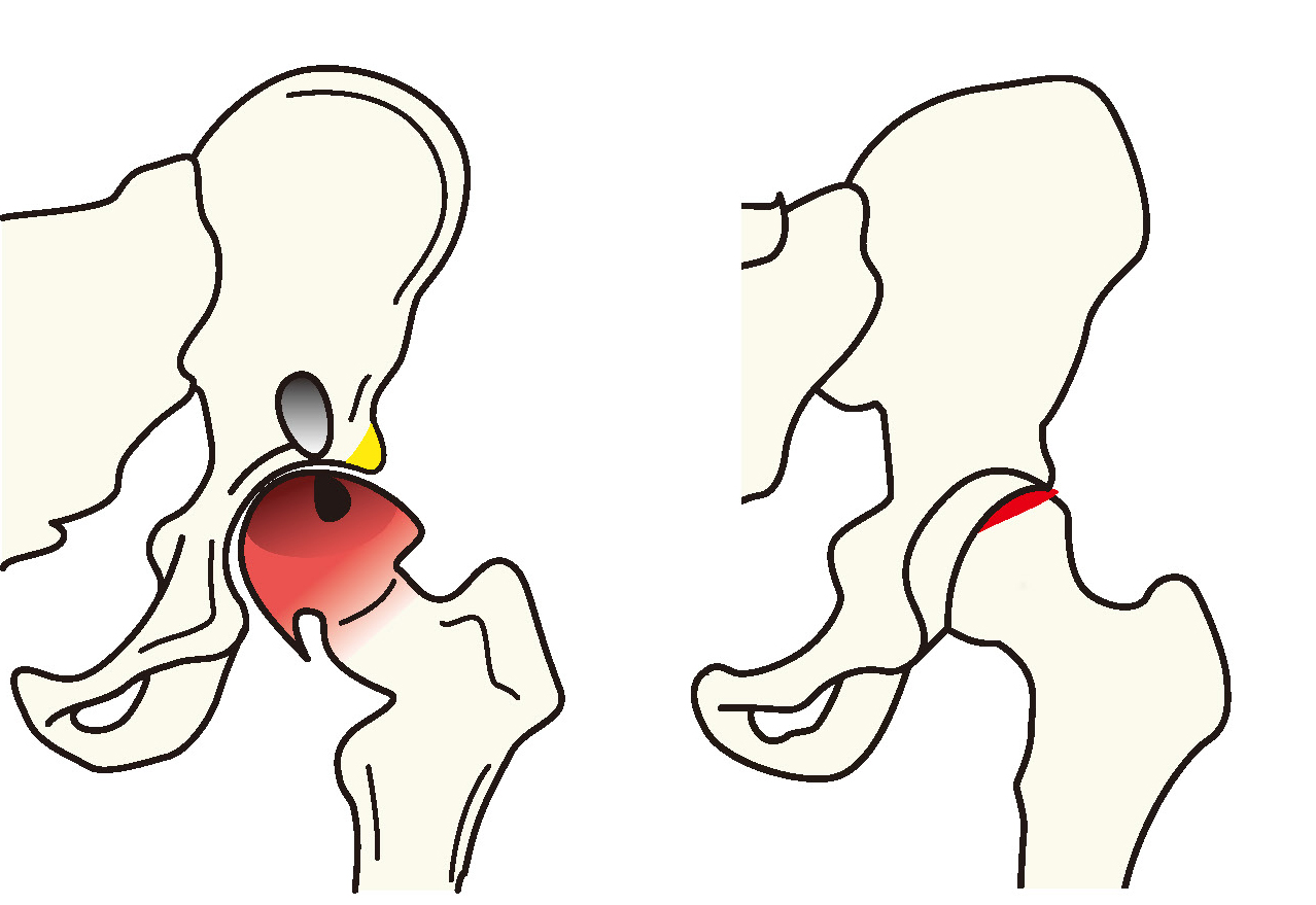 大腿骨頭壊死症と股関節唇損傷