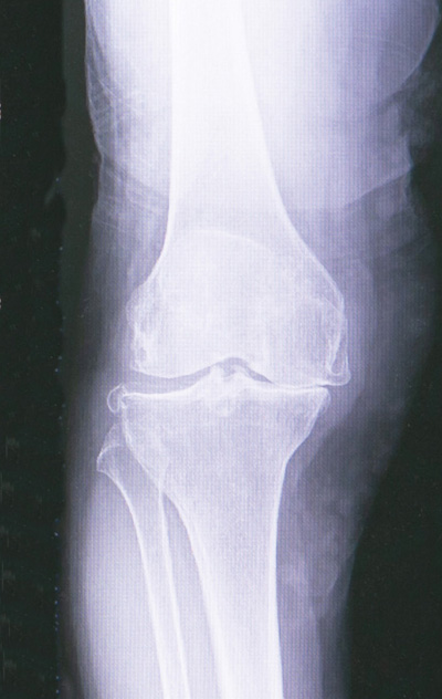 変形性膝関節症のレントゲン