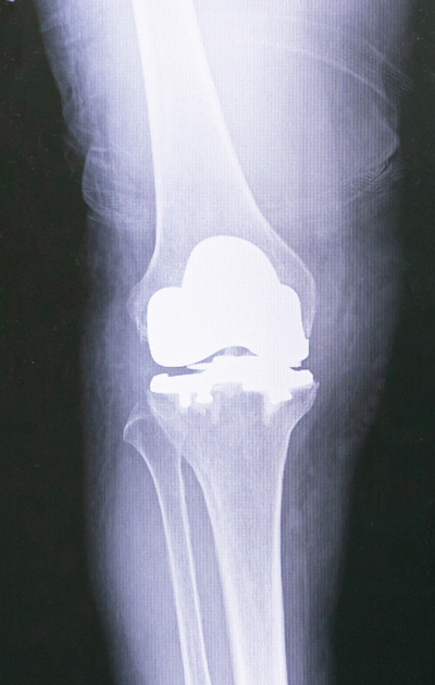 人工膝関節全置換術後のレントゲン