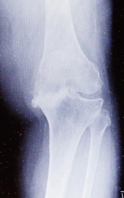 高度に内反した膝関節のレントゲン