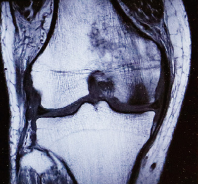 部分的に傷んだ膝関節のMRI