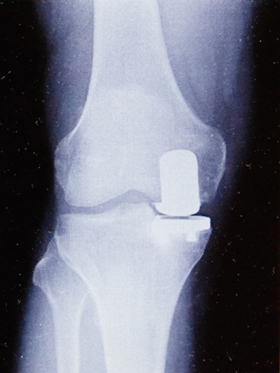 人工膝関節部分置換術後のレントゲン