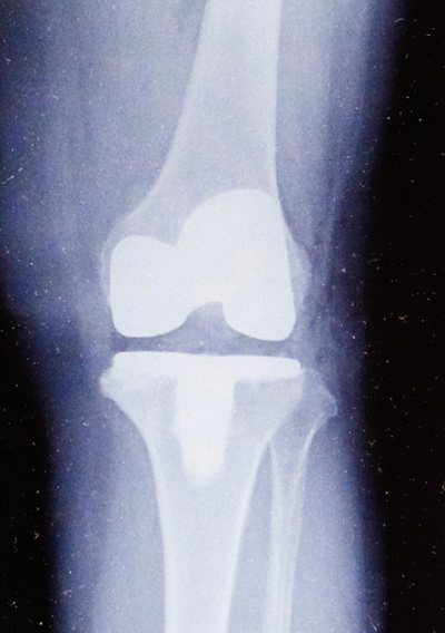 人工膝関節全置換術後のレントゲン