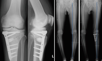 骨切り術後のレントゲン（正面と側面）術前と術後のレントゲン（荷重が脚の中心を通るようになっています）