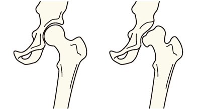 正常の股関節と発育性股関節形成不全