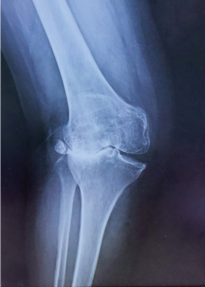 変形性膝関節症のレントゲン