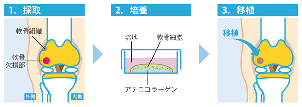 自家培養軟骨移植術