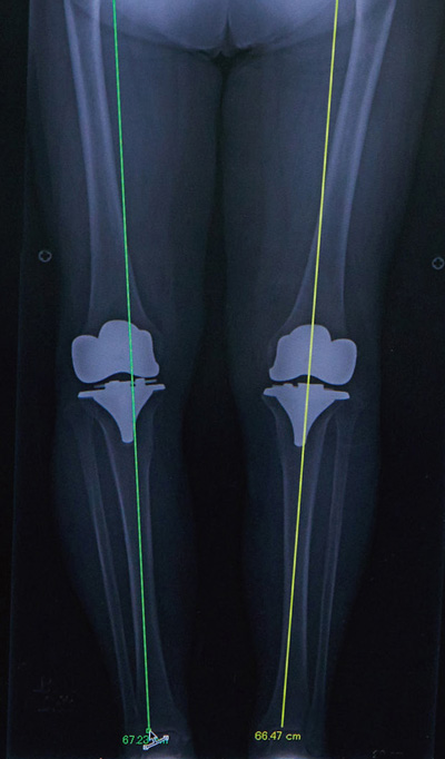 両足同時人工膝関節全置換術後のレントゲン