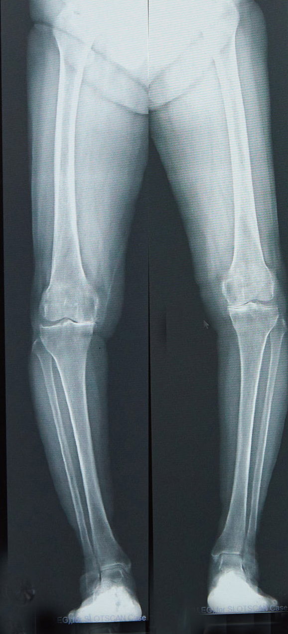 O脚により膝関節の内側が傷んでいるレントゲン