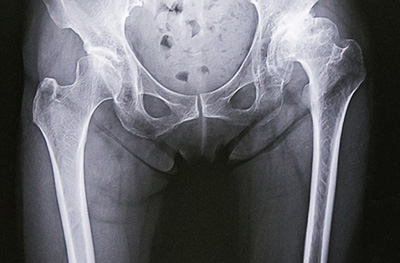 変形性股関節症のレントゲン