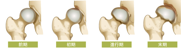 変形性股関節症の進行